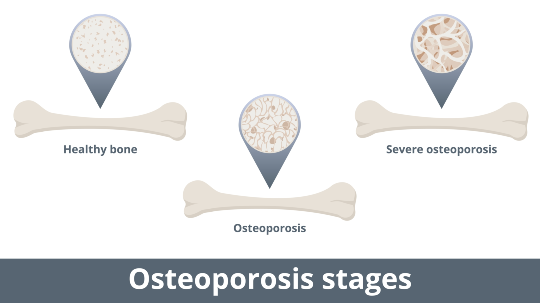 Bone-health
